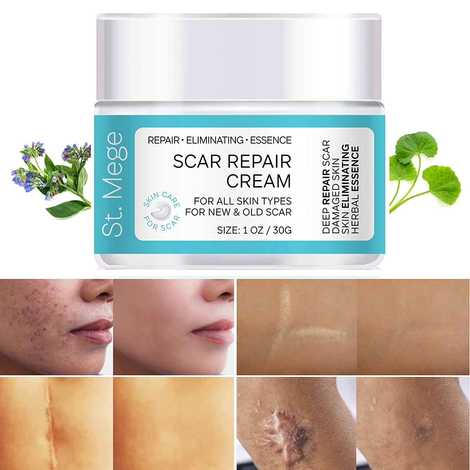 Scar Removal Cream, Scar Cream For Old Scars - Stretch Mark Removal Cream for Men & Women - Stretch Marks Relief and Burns Repair, Face Skin Repair Cream