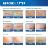 Medical-Grade Drug Free Silicone Scar Sheets for C-Section, Softens & Flattens Stretch Marks